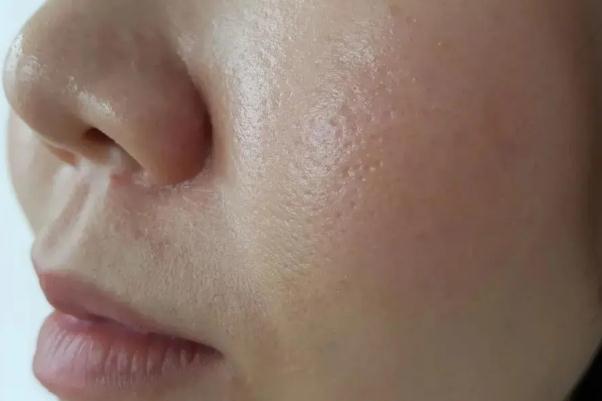 皮膚出油的表現(xiàn) 皮膚出油的好處 皮膚出油的表現(xiàn) 皮膚出油的好處