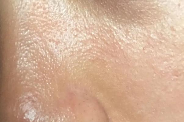 皮膚出油要用洗面奶嗎 皮膚出油要一直吃異維A酸嗎 皮膚出油要用洗面奶嗎 皮膚出油要一直吃異維A酸嗎