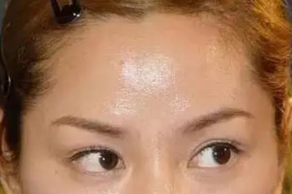 皮膚出油可以直接用散粉嗎 皮膚出油可以吃維生素B6調(diào)理嗎 皮膚出油可以直接用散粉嗎 皮膚出油可以吃維生素B6調(diào)理嗎