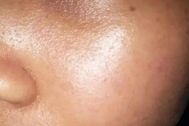 皮膚出油多是什么原因 皮膚出油嚴(yán)重毛孔粗大如何改善 皮膚出油多是什么原因 皮膚出油嚴(yán)重毛孔粗大如何改善