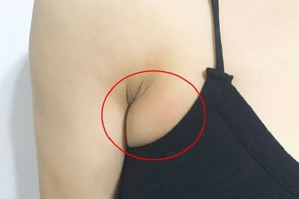 副乳切除手術(shù)什么季節(jié)做最好 副乳切除手術(shù)可以在整形醫(yī)院做嗎 副乳切除手術(shù)什么季節(jié)做最好 副乳切除手術(shù)可以在整形醫(yī)院做嗎