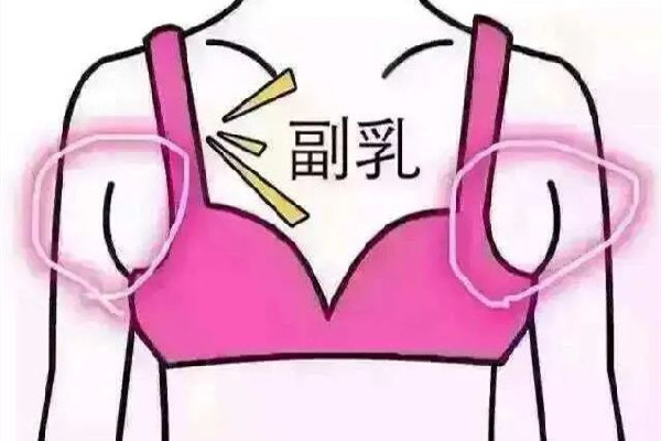 副乳切除手術(shù)會有疤痕嗎 副乳切除手術(shù)怎么才能看不到疤痕 副乳切除手術(shù)會有疤痕嗎 副乳切除手術(shù)怎么才能看不到疤痕