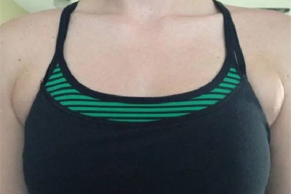 副乳切除手術(shù)什么季節(jié)做最好 副乳切除手術(shù)可以在整形醫(yī)院做嗎 副乳切除手術(shù)什么季節(jié)做最好 副乳切除手術(shù)可以在整形醫(yī)院做嗎