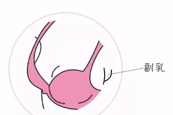 切副乳手術(shù)多少錢 切副乳手術(shù)可以報銷嗎 切副乳手術(shù)多少錢 切副乳手術(shù)可以報銷嗎
