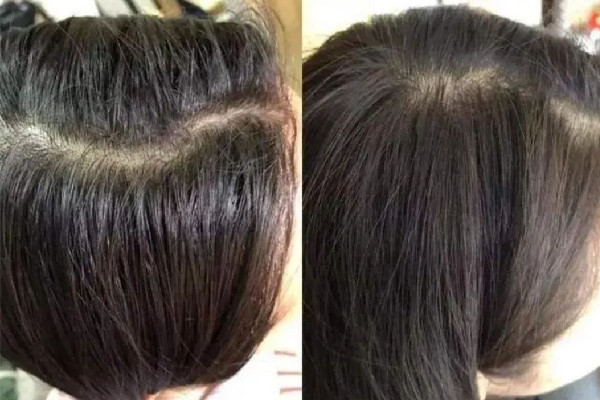 頭發(fā)愛出油還脫發(fā)怎么辦 頭發(fā)為什么總是很油 頭發(fā)愛出油還脫發(fā)怎么辦 頭發(fā)為什么總是很油