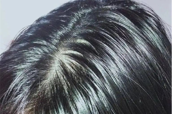 頭發(fā)愛出油還脫發(fā)怎么辦 頭發(fā)為什么總是很油 頭發(fā)愛出油還脫發(fā)怎么辦 頭發(fā)為什么總是很油
