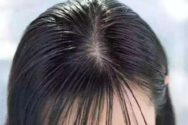 頭發(fā)出油要用什么洗發(fā)水 頭發(fā)出油用香皂洗頭可以嗎 頭發(fā)出油要用什么洗發(fā)水 頭發(fā)出油用香皂洗頭可以嗎