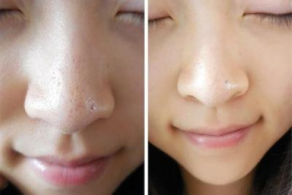 去黑頭后用什么修復(fù) 去黑頭后可以用爽膚水收縮毛孔嗎 去黑頭后用什么修復(fù) 去黑頭后可以用爽膚水收縮毛孔嗎