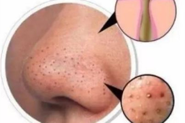 去黑頭在面膜前還是后 去黑頭什么時(shí)候時(shí)間去好 去黑頭在面膜前還是后 去黑頭什么時(shí)候時(shí)間去好