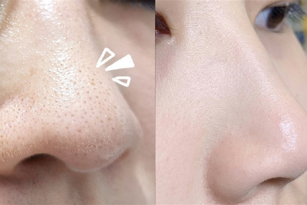 黑頭粉刺怎么才能徹底根除 黑頭要去看醫(yī)生嗎 黑頭粉刺怎么才能徹底根除 黑頭要去看醫(yī)生嗎