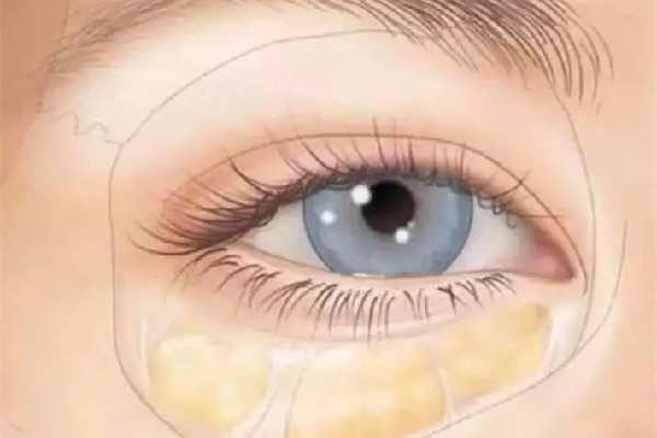 武漢淚溝填充哪家醫(yī)院最好 武漢淚溝脂肪填充多少錢 武漢淚溝填充哪家醫(yī)院最好 武漢淚溝脂肪填充多少錢