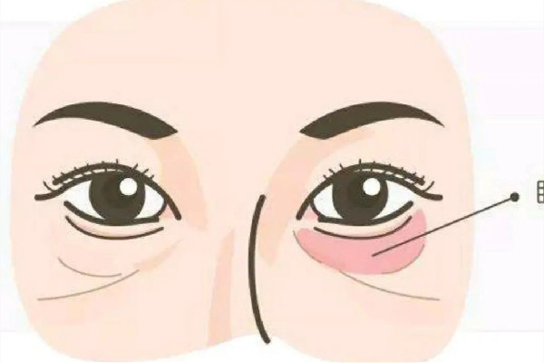 武漢去眼袋最好有醫(yī)院排名 武漢美基元去眼袋怎么樣 武漢去眼袋最好有醫(yī)院排名 武漢美基元去眼袋怎么樣