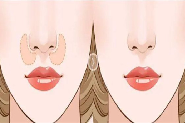 武漢玻尿酸整鼻子能維持多久 武漢整鼻子哪家醫(yī)院好 武漢玻尿酸整鼻子能維持多久 武漢整鼻子哪家醫(yī)院好