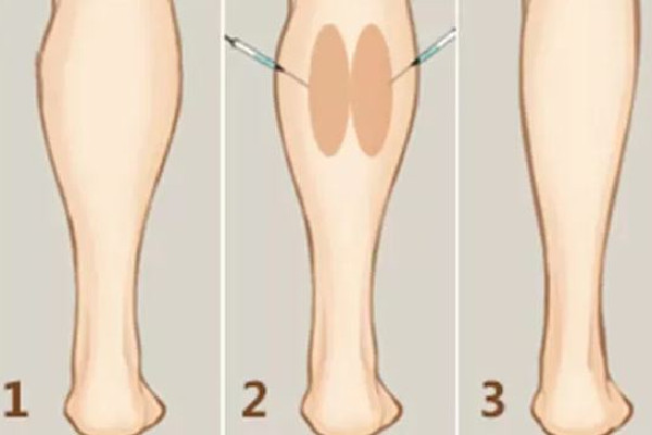 武漢打瘦腿針的醫(yī)院推薦 武漢打瘦腿針要多少錢 武漢打瘦腿針的醫(yī)院推薦 武漢打瘦腿針要多少錢