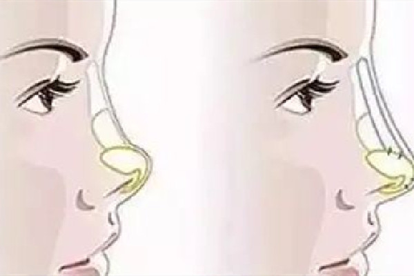 武漢墊鼻子哪個(gè)醫(yī)院好 武漢墊鼻子要多少錢 武漢墊鼻子哪個(gè)醫(yī)院好 武漢墊鼻子要多少錢