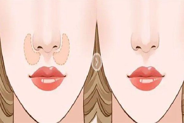 武漢墊鼻子哪個(gè)醫(yī)院好 武漢墊鼻子要多少錢 武漢墊鼻子哪個(gè)醫(yī)院好 武漢墊鼻子要多少錢