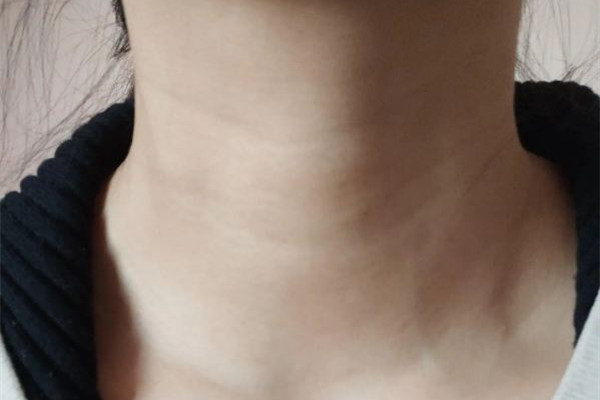 武漢嗨體去頸紋多少錢 武漢去頸紋好的醫(yī)院 武漢嗨體去頸紋多少錢 武漢去頸紋好的醫(yī)院