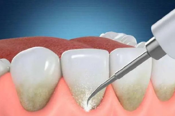 武漢洗牙較好的醫(yī)院 武漢洗牙一次大概多少錢 武漢洗牙較好的醫(yī)院 武漢洗牙一次大概多少錢