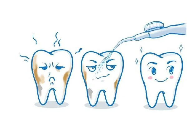 武漢洗牙較好的醫(yī)院 武漢洗牙一次大概多少錢 武漢洗牙較好的醫(yī)院 武漢洗牙一次大概多少錢
