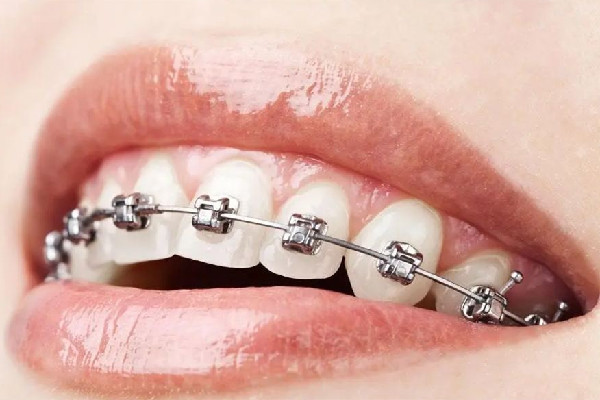 武漢矯正牙齒哪家醫(yī)院好 武漢矯正牙齒多少錢 武漢矯正牙齒哪家醫(yī)院好 武漢矯正牙齒多少錢