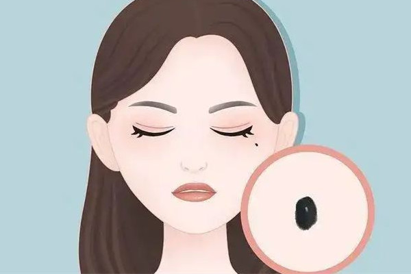 武漢激光點(diǎn)痣醫(yī)院哪家好 武漢點(diǎn)痣哪里弄的干凈 武漢激光點(diǎn)痣醫(yī)院哪家好 武漢點(diǎn)痣哪里弄的干凈