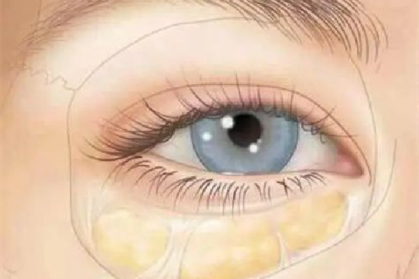 武漢淚溝填充哪家比較好 武漢哪家醫(yī)院淚溝修復(fù)好 武漢淚溝填充哪家比較好 武漢哪家醫(yī)院淚溝修復(fù)好