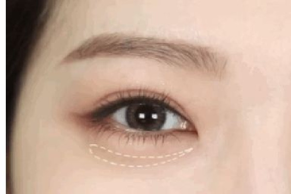 武漢填充臥蠶哪家好 武漢臥蠶手術哪個醫(yī)院做的好 武漢填充臥蠶哪家好 武漢臥蠶手術哪個醫(yī)院做的好