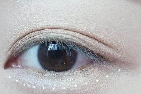 武漢豐臥蠶哪家醫(yī)院好 武漢做臥蠶大概多少錢 武漢豐臥蠶哪家醫(yī)院好 武漢做臥蠶大概多少錢