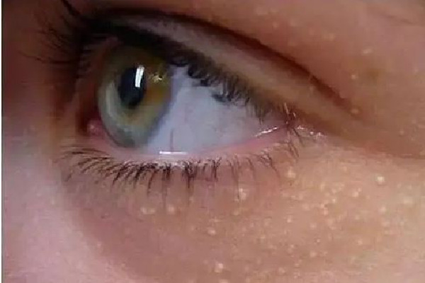 武漢去脂肪粒那家醫(yī)院比較好 武漢去脂肪粒多少錢 武漢去脂肪粒那家醫(yī)院比較好 武漢去脂肪粒多少錢