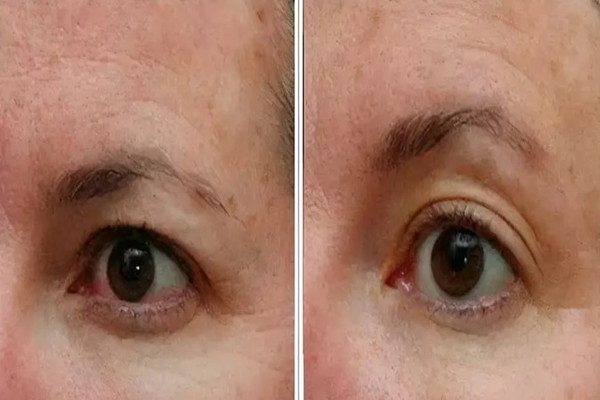 武漢可以做眼部松弛的醫(yī)院 武漢做眼部松弛價(jià)格 武漢可以做眼部松弛的醫(yī)院 武漢做眼部松弛價(jià)格