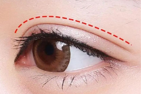 武漢眼角上揚手術多少錢 武漢眼角上揚手術去哪家醫(yī)院 武漢眼角上揚手術多少錢 武漢眼角上揚手術去哪家醫(yī)院