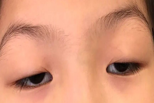 武漢上眼瞼下垂哪個醫(yī)院做的好 武漢上眼瞼下垂修復(fù)手術(shù)要多少錢 武漢上眼瞼下垂哪個醫(yī)院做的好 武漢上眼瞼下垂修復(fù)手術(shù)要多少錢