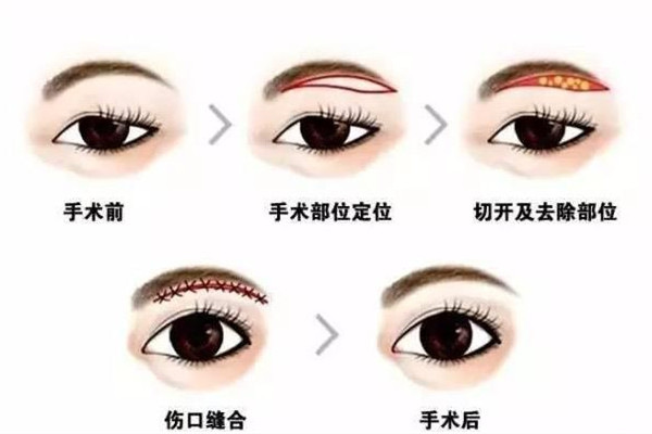 武漢提眉手術(shù)哪個(gè)醫(yī)院做的好 武漢提眉手術(shù)需要多少錢 武漢提眉手術(shù)哪個(gè)醫(yī)院做的好 武漢提眉手術(shù)需要多少錢