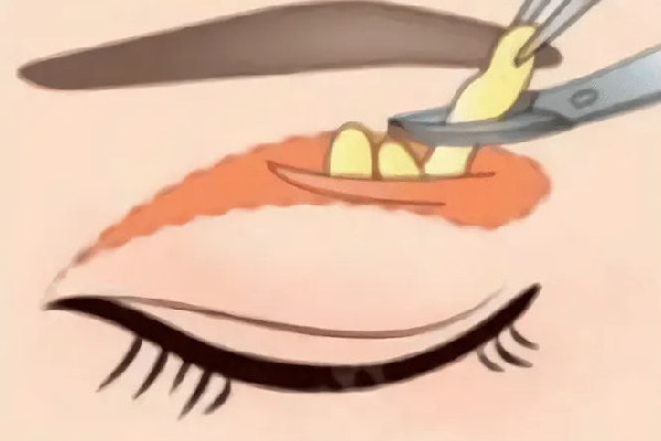 武漢腫眼泡抽脂哪個(gè)醫(yī)院好 武漢做腫眼泡抽脂多少錢 武漢腫眼泡抽脂哪個(gè)醫(yī)院好 武漢做腫眼泡抽脂多少錢