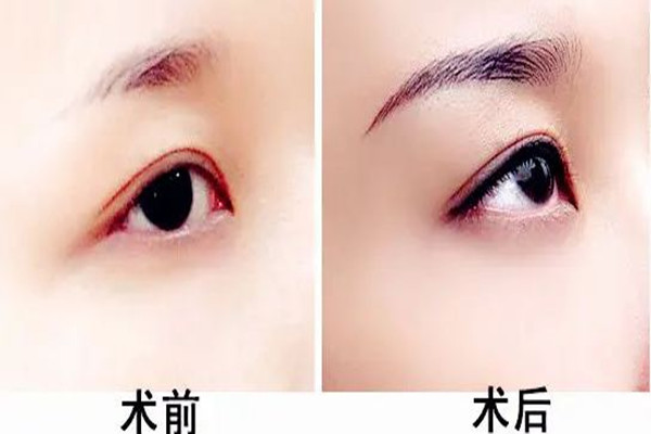 武漢提眉手術(shù)哪個(gè)醫(yī)院做的好 武漢提眉手術(shù)需要多少錢 武漢提眉手術(shù)哪個(gè)醫(yī)院做的好 武漢提眉手術(shù)需要多少錢