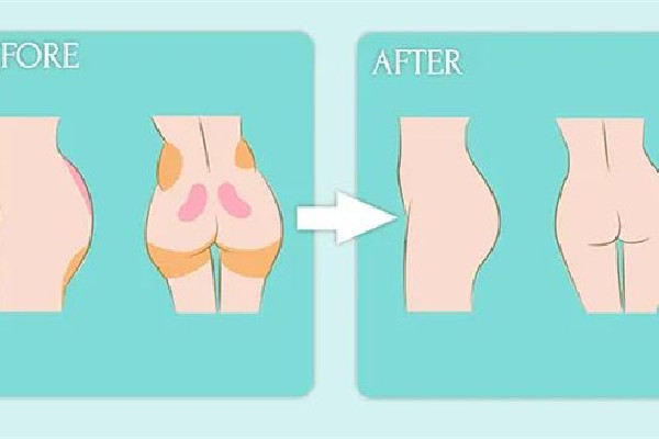 武漢假體臀部整形醫(yī)院 武漢假體臀部整形多少錢