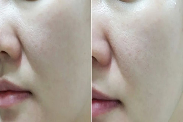 江漢路步行街skin79皮膚管理中心去黑頭效果怎么樣 江漢路步行街skin79皮膚管理中心可以深層清潔嗎 江漢路步行街skin79皮膚管理中心去黑頭效果怎么樣 江漢路步行街skin79皮膚管理中心可以深層清潔嗎