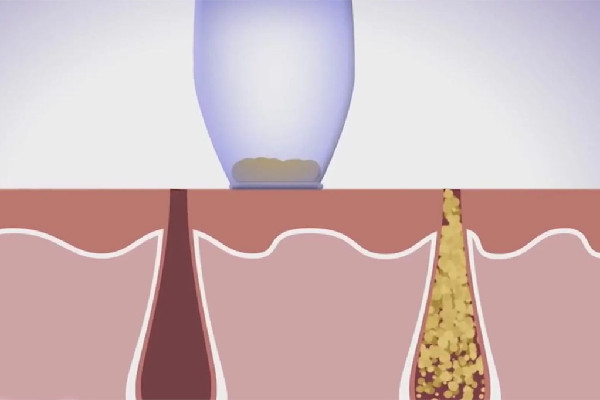 江漢路步行街愛漾皮膚管理中心毛孔清潔怎么樣 江漢路步行街愛漾皮膚管理中心毛孔管理怎么樣 江漢路步行街愛漾皮膚管理中心毛孔清潔怎么樣 江漢路步行街愛漾皮膚管理中心毛孔管理怎么樣