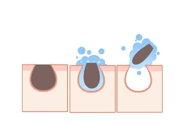 江漢路步行街SOR索爾祛痘面部肌膚科學管理祛痘效果怎么樣 江漢路步行街SOR索爾祛痘面部肌膚科學管理毛孔清潔好嗎 江漢路步行街SOR索爾祛痘面部肌膚科學管理祛痘效果怎么樣 江漢路步行街SOR索爾祛痘面部肌膚科學管理毛孔清潔好嗎