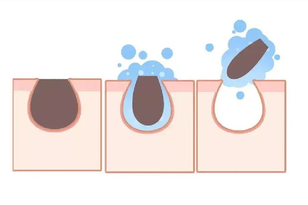 光谷科保顏皮膚管理中心針清效果怎么樣 光谷科保顏皮膚管理中心去黑頭去的干凈嗎 光谷科保顏皮膚管理中心針清效果怎么樣 光谷科保顏皮膚管理中心去黑頭去的干凈嗎