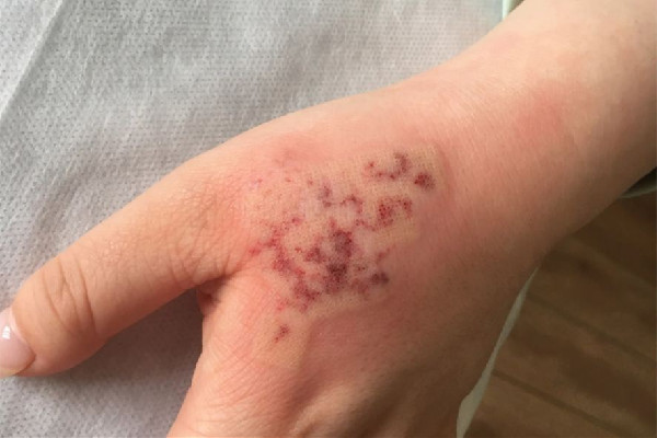 江漢路步行街眾刺紋畫·穿刺·洗紋身·遮蓋店洗紋身會(huì)疼嗎 洗紋身的方法有幾種 江漢路步行街眾刺紋畫·穿刺·洗紋身·遮蓋店洗紋身會(huì)疼嗎 洗紋身的方法有幾種