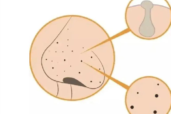 光谷EM輕松時(shí)刻科技美容店去黑頭效果怎么樣 去黑頭可以管多久 光谷EM輕松時(shí)刻科技美容店去黑頭效果怎么樣 去黑頭可以管多久