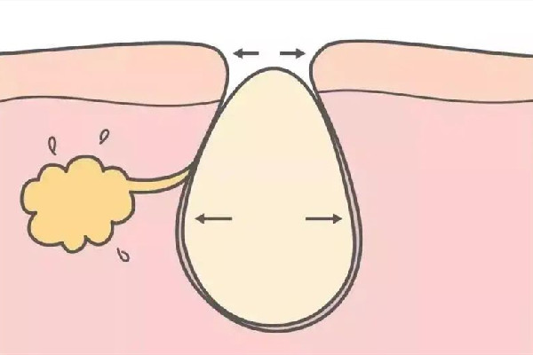 水果湖愛漾皮膚管理中心清潔毛孔后感覺怎么樣 清潔毛孔是去角質(zhì)嗎 水果湖愛漾皮膚管理中心清潔毛孔后感覺怎么樣 清潔毛孔是去角質(zhì)嗎