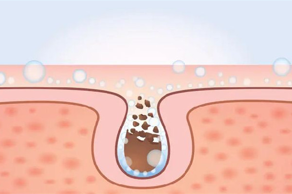 水果湖愛漾皮膚管理中心清潔毛孔后感覺怎么樣 清潔毛孔是去角質(zhì)嗎 水果湖愛漾皮膚管理中心清潔毛孔后感覺怎么樣 清潔毛孔是去角質(zhì)嗎