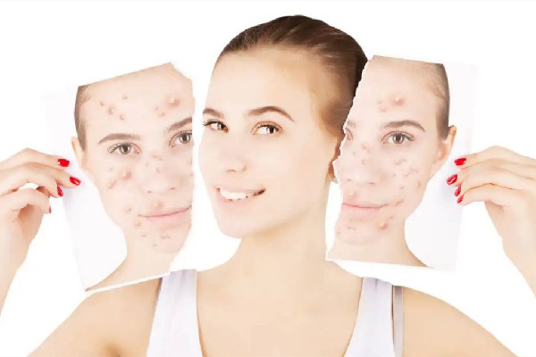 積玉橋俏佳人美容形象會(huì)所痘痘肌清理怎么樣 痘痘肌膚適合用什么洗面奶 積玉橋俏佳人美容形象會(huì)所痘痘肌清理怎么樣 痘痘肌膚適合用什么洗面奶