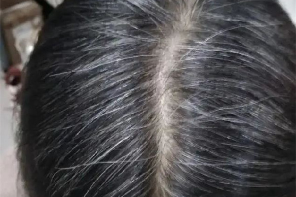 白頭發(fā)越來(lái)越多是身體哪里有問題 白頭發(fā)多和腎虛有關(guān)系嗎