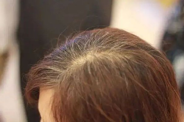 白頭發(fā)吃中藥能調(diào)理好嗎 白頭發(fā)多久能變黑 白頭發(fā)吃中藥能調(diào)理好嗎 白頭發(fā)多久能變黑