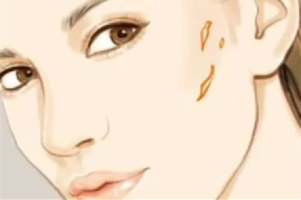 中南路正璞醫(yī)療美容·痘坑疤痕&皮膚微整店祛疤效果怎么樣 祛疤會越來越嚴重嗎 中南路正璞醫(yī)療美容·痘坑疤痕&皮膚微整店祛疤效果怎么樣 祛疤會越來越嚴重嗎