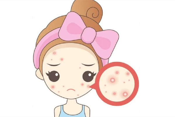 中南路蕾特恩專業(yè)祛痘·面部皮膚管理店痘痘肌護理好嗎 痘痘肌要一輩子忌口嗎 中南路蕾特恩專業(yè)祛痘·面部皮膚管理店痘痘肌護理好嗎 痘痘肌要一輩子忌口嗎