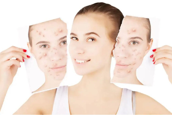 中南路夢(mèng)都?巴厘女子SPA養(yǎng)生會(huì)所痘肌清理怎么樣 痘痘肌做小氣泡有用嗎 中南路夢(mèng)都?巴厘女子SPA養(yǎng)生會(huì)所痘肌清理怎么樣 痘痘肌做小氣泡有用嗎